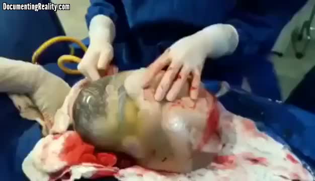 698963d1471093995-baby-born-still-inside-amniotic-sac-babybornstill