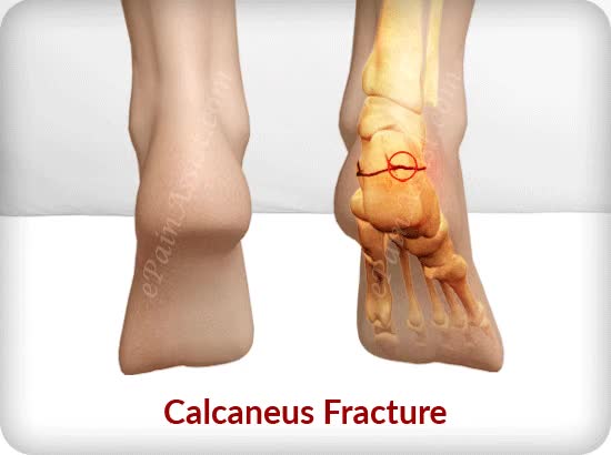 Calcaneus Fracture - ePainAssist.com