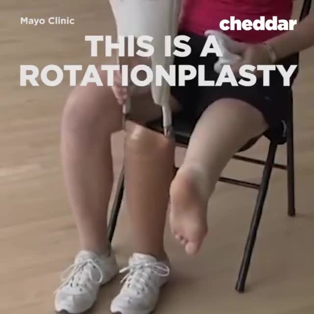 Rotationplasty turns your ankle into a knee joint.