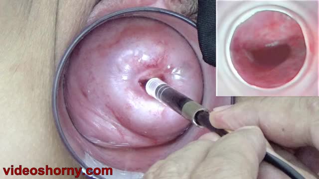 Japanese Endoscope Camera in Cervix to Watch Inside of the Uterus