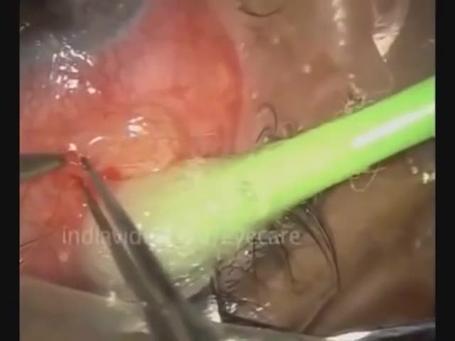 Surgical removal of live worm from eye