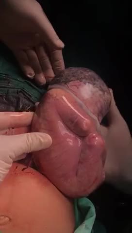 ripsave - Baby born with amniotic sac intact (1)