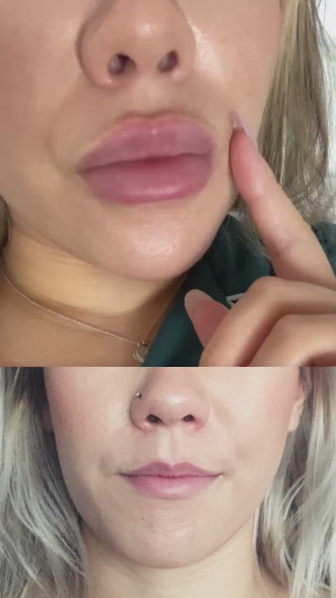 Lip filler progress over several years - 4ml or 5ml - should I get more or stop here?