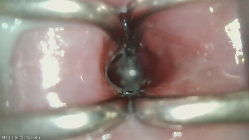 endocervical endoscopy