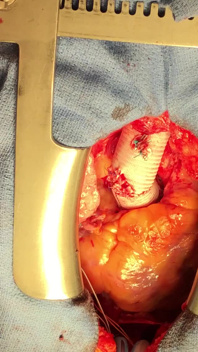 Valve-sparing Root, Ascending, Hemiarch Replacement