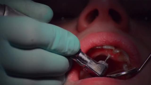 Dental Crowns Specialist At Florida Dental Care of Miller