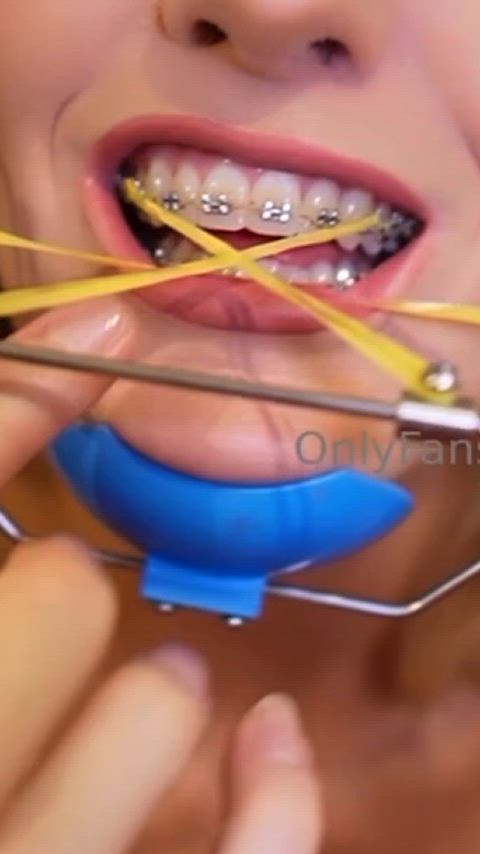 braces petite small tits braceface gif