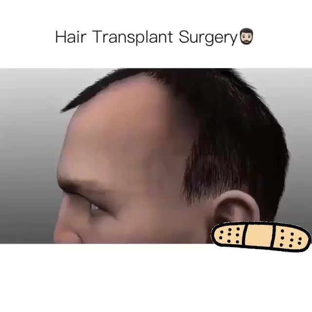 This is hair transplant is done!