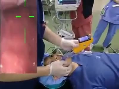 Intubation with the Help of a Camera