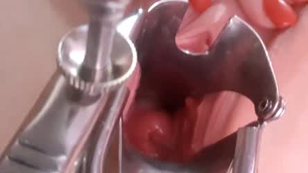 Shows The Uterus In Close-Up Through A Speculum