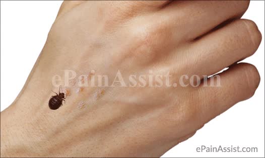 Bedbug Bite - ePainAssist.com