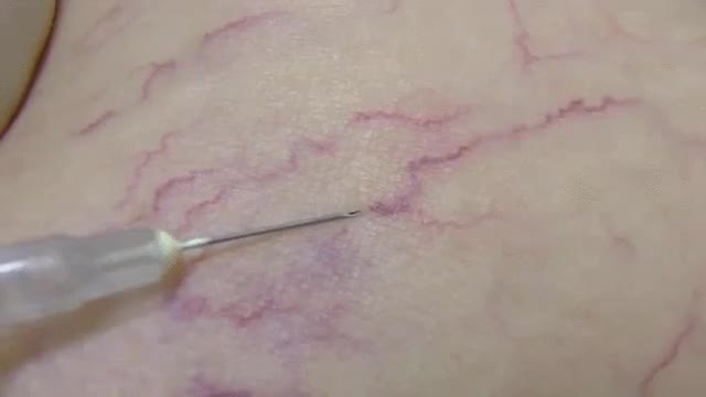Immediate treatment of spider veins with sclerosant