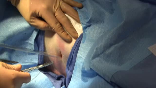 Chest Tube Tie In